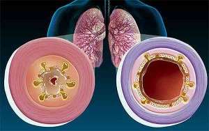 Бронхит - описание и лечение народными средствами
