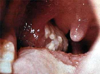 Дифтерия - фото, описание болезни