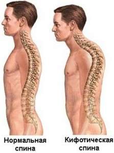 Кифоз