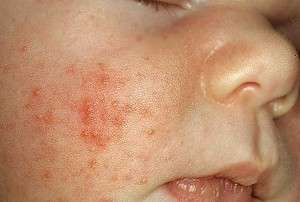 Сыпь у новорожденных - что делать