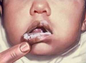 Молочница у детей