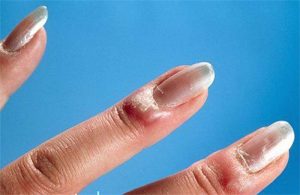 Нарывы (abscess)