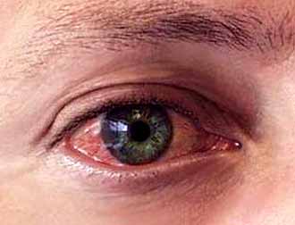 Конъюнктивит