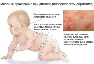 Местные проявления при диатезе (Local manifestations in diathesis)