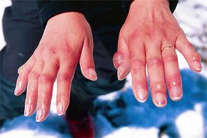 Отморожения. Ознобления