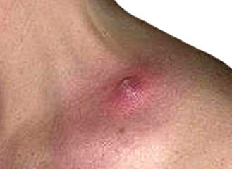 Фрункулез - описание, фото