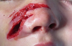 Раны и порезы - народные средства для заживления