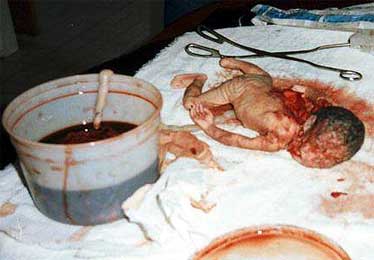 Абортированный ребенок - фото