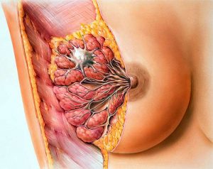 Мастит (mastitis)