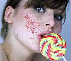 Избавляемся от угрей