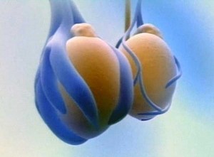 Варикоцеле - описание болезни