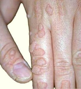 Бородавки - описание, виды бородавок