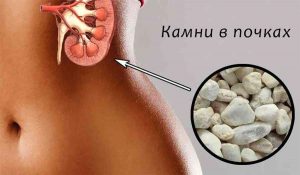 Очищение почек от камней оксалатов (Cleansing the kidneys from oxalate stones)