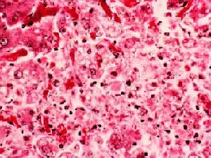 Инфекции кровяные