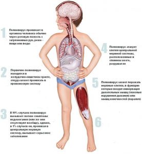 Полиомиелит (Polio)