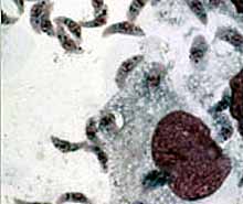 Токсоплазмоз