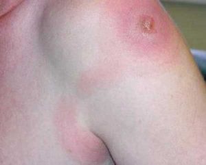 Лимфангит - картинка