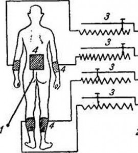 Схема включения больного при общей диатермии через распределитель тока