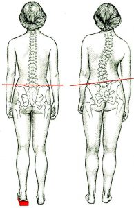 Искривление позвоночника