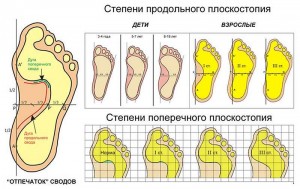 Таблица определения степени плоскостопия