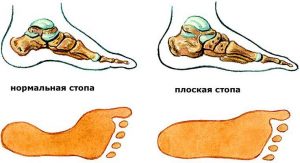 Плоскостопие нормальная стопа и плоская стопа