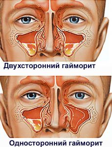 Гайморит: описание и лечение в домашних условиях