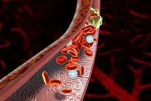 Профилактика образования тромбов