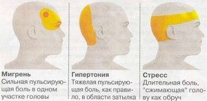 Домашнее лечение головной боли (Home treatment of headache)