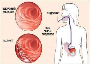Изображение гастрита (gastritis view)