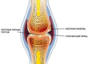 Остеоартроз (osteoarthrosis)